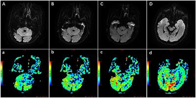 Endovascular Recanalization for Symptomatic Subacute to Chronic Atherosclerotic Basilar Artery Occlusion